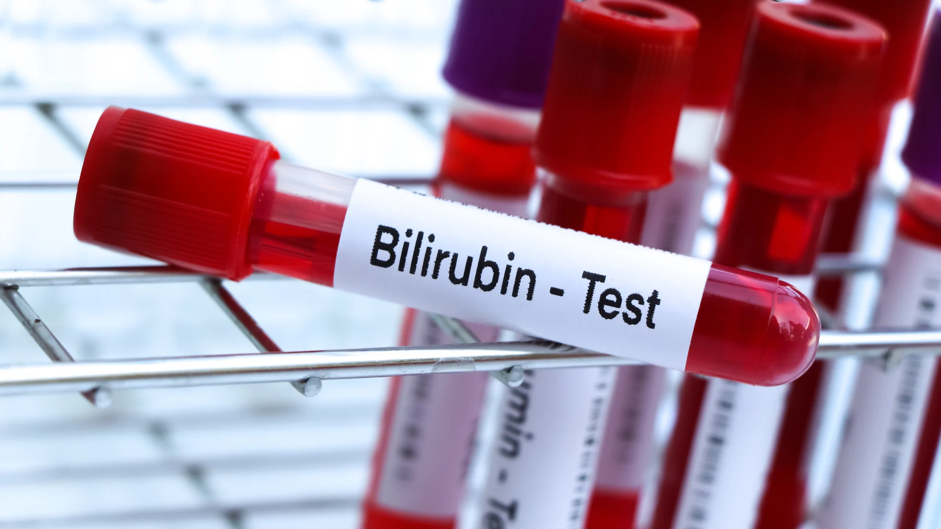 Total and Direct Bilirubin Test